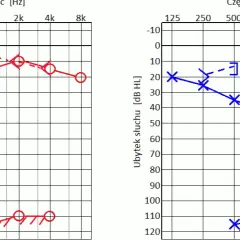 Audiogram - jak wygląda badanie słuchu i ile faktycznie trwa u specjalisty