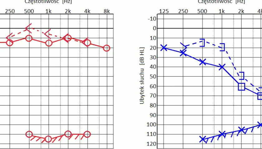 Audiogram - jak wygląda badanie słuchu i ile faktycznie trwa u specjalisty