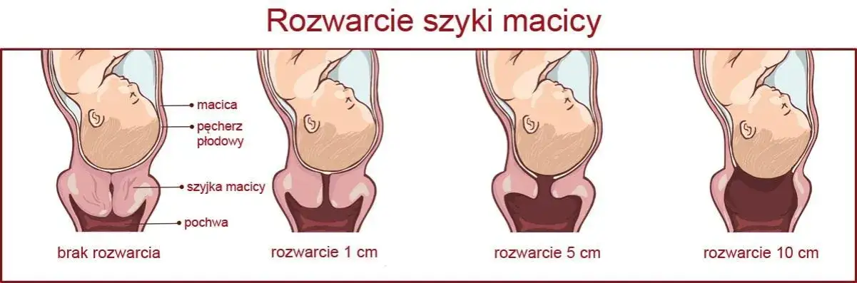 Zdjęcie Rozwarcie szyjki macicy 1 cm: co dalej i ile zostało do porodu?